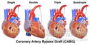 血管支架的研發(fā)與技術發(fā)展