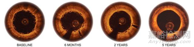 血管支架的研發(fā)與技術發(fā)展