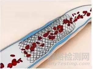 生物可降解血管支架的臨床進展、目前存在問題和未來發(fā)展方向