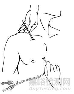 長(zhǎng)期血液透析導(dǎo)管技術(shù)特點(diǎn)