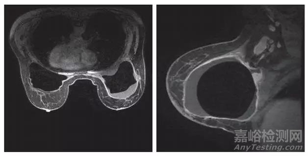 【醫(yī)械問答】對于乳房植入體相關間變大細胞淋巴瘤的審評關注