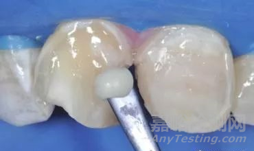 口腔材料的發(fā)展歷史