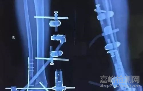 醫(yī)用材料新寵兒——碳纖維復(fù)合材料