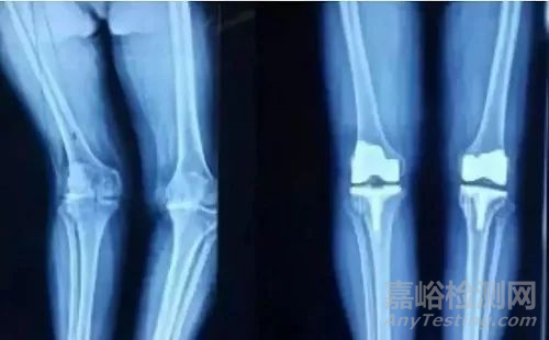 醫(yī)用材料新寵兒——碳纖維復(fù)合材料