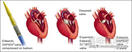 多層醫(yī)用導(dǎo)管的生產(chǎn)、研發(fā)技術(shù)與產(chǎn)品知識