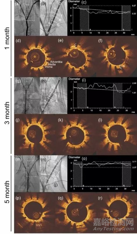 可降解鎂合金血管支架研究取得重要進展 