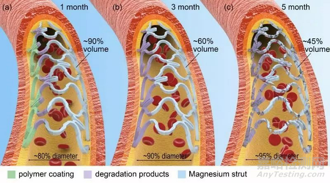 可降解鎂合金血管支架研究取得重要進展 