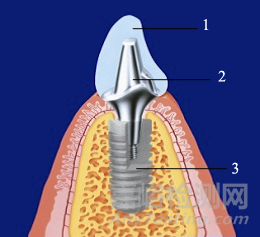牙種植體基臺產(chǎn)品注冊技術(shù)審查指導(dǎo)原則 ( 征求意見稿)