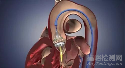 血管介入常用器械簡介
