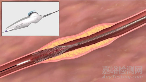 我國(guó)首個(gè)外周藥物洗脫支架獲批上市