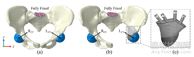 骨盆個(gè)性化重建的生物力學(xué)分析
