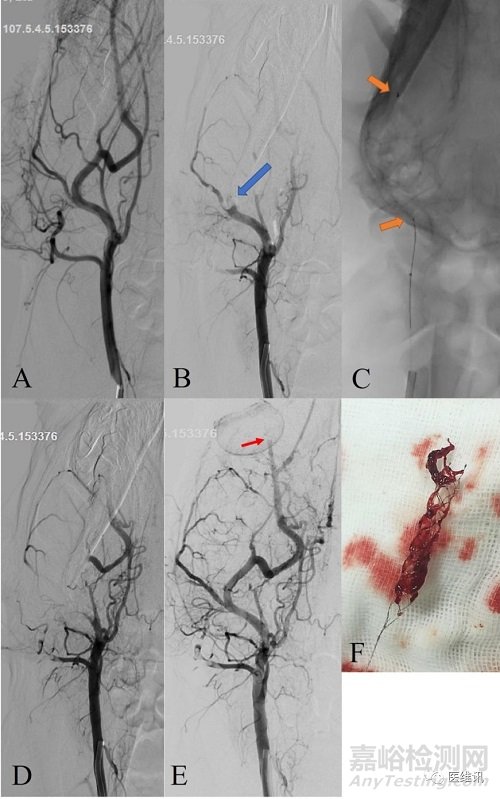 取栓支架產(chǎn)品獲批上市，與美敦力產(chǎn)品比較試驗