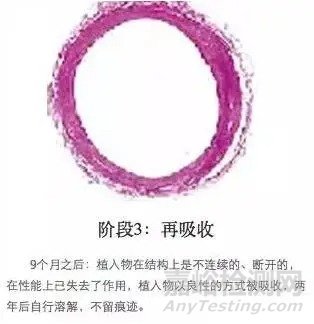 生物可降解支架的介紹及原理