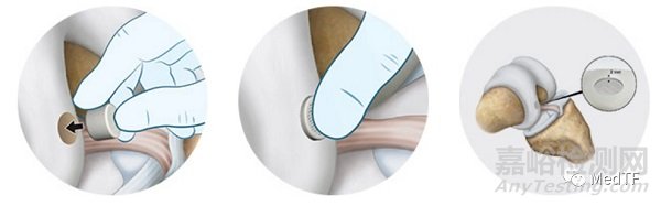 Agili-C:軟骨再造技術(shù)的植入過程及治療機(jī)理