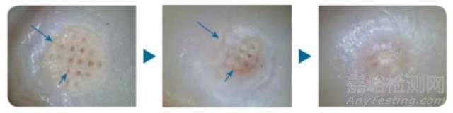 Agili-C:軟骨再造技術(shù)的植入過程及治療機(jī)理