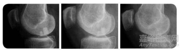 Agili-C:軟骨再造技術(shù)的植入過程及治療機(jī)理