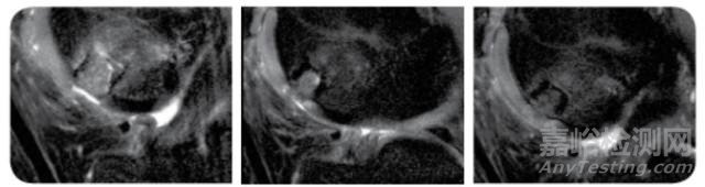 Agili-C:軟骨再造技術(shù)的植入過程及治療機(jī)理