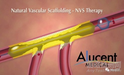Alucent NVS:“天然支架”有望避免動(dòng)靜脈瘺再狹窄