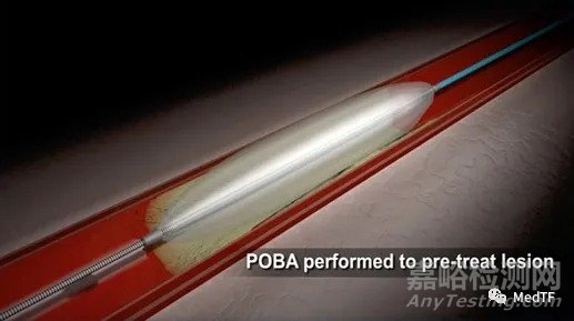 Alucent NVS:“天然支架”有望避免動(dòng)靜脈瘺再狹窄