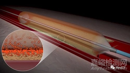 Alucent NVS:“天然支架”有望避免動(dòng)靜脈瘺再狹窄