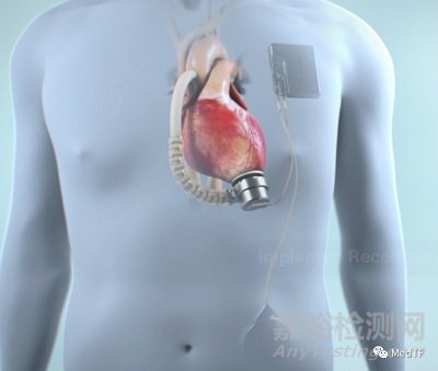Corvion LVAD:首個完全植入LVAD的優(yōu)勢介紹