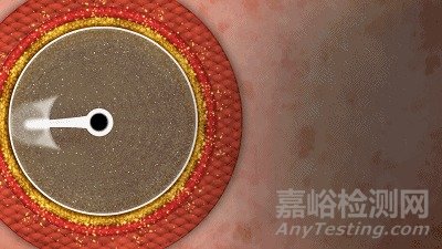 MagicTouch SCB：小冠狀動脈藥物球囊