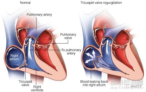 TricValve：首個(gè)上下腔靜脈植入瓣膜治療三尖瓣關(guān)閉不全
