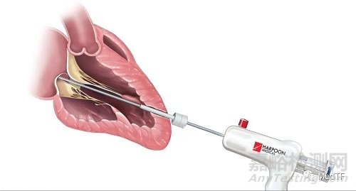 HARPOON：愛德華啟動大規(guī)模二尖瓣修復(fù)臨床試驗