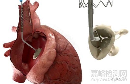 CroíValve：可逆三尖瓣修復(fù)技術(shù)