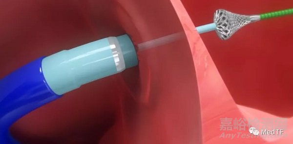 ATRIAL SHUNT CATHETER:無植入物的房間隔分流裝置