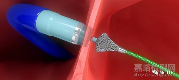 ATRIAL SHUNT CATHETER:無植入物的房間隔分流裝置