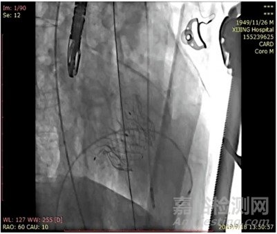 中國首款二尖瓣置換系統(tǒng)Mi-thos?正式進入注冊臨床研究
