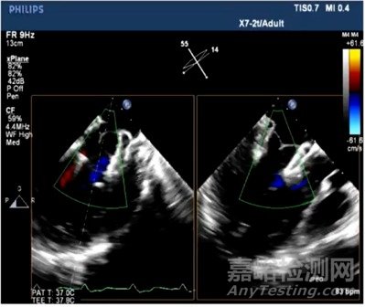 中國首款二尖瓣置換系統(tǒng)Mi-thos?正式進入注冊臨床研究