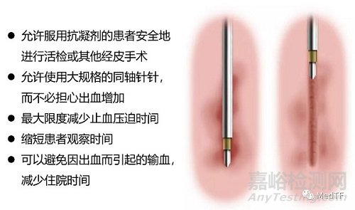 HemoStop Bx：經(jīng)皮介入手術(shù)止血新技術(shù)