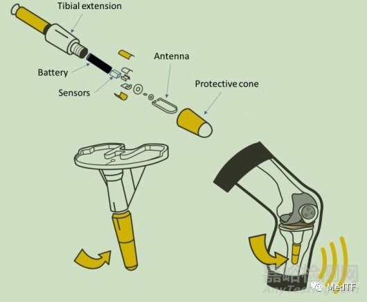 Canary：智能骨科植入物，實(shí)時監(jiān)測術(shù)后恢復(fù)