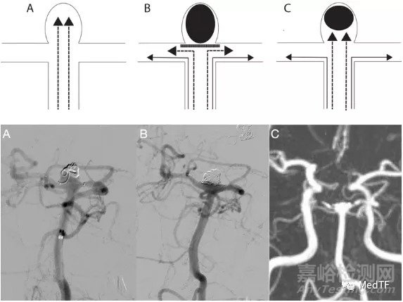 eCLIPs:類蜈蚣似的動(dòng)脈瘤治療器械