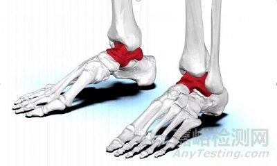 FDA批準(zhǔn)了世界上首個(gè)針對(duì)患者的3D打印距骨植入物