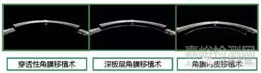 國產(chǎn)人工角膜6月用于臨床，超全的人工角膜研發(fā)科普貼