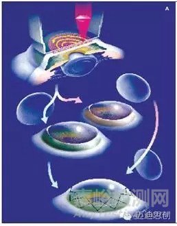 國產(chǎn)人工角膜6月用于臨床，超全的人工角膜研發(fā)科普貼