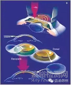 國產(chǎn)人工角膜6月用于臨床，超全的人工角膜研發(fā)科普貼