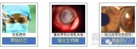 國產(chǎn)人工角膜6月用于臨床，超全的人工角膜研發(fā)科普貼