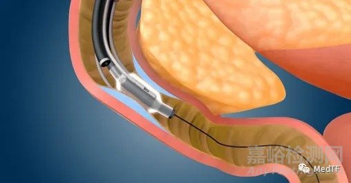 Revita：2型糖尿病治療新技術