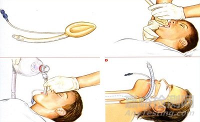 泛談中美醫(yī)療器械的分類管理