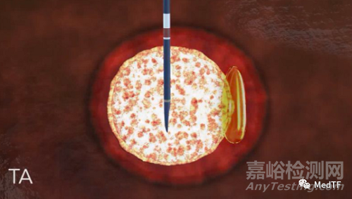 HeatSYNC Gel：讓微波消融變更為圓潤(rùn)