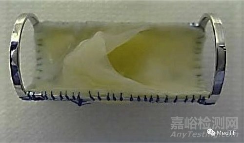 VenoValve：有望解決下肢慢性靜脈功能不全患者長(zhǎng)期困擾