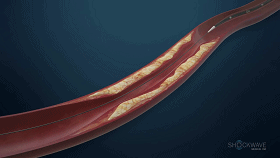 PTCA球囊的應(yīng)用與發(fā)展