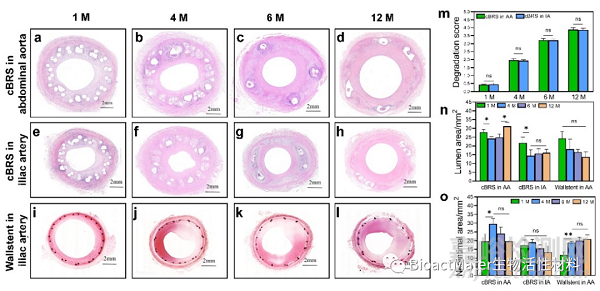 機械自增強型復合結(jié)構(gòu)可降解血管支架簡介