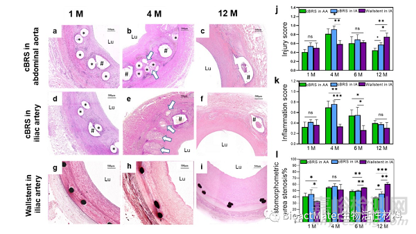 機械自增強型復合結(jié)構(gòu)可降解血管支架簡介