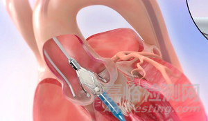 “Jenavalve” Trilogy TAVI 輸送系統(tǒng)獲CE審批，使自膨主瓣和輸送系統(tǒng)成為可能