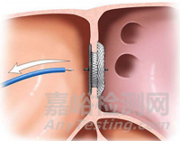 葛均波院士團(tuán)隊(duì)首創(chuàng)可穿刺放入的房缺封堵器